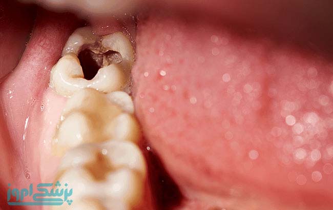تاثیر کامپوزیتهای جدید آنتی باکتریال در مقاومت دندان