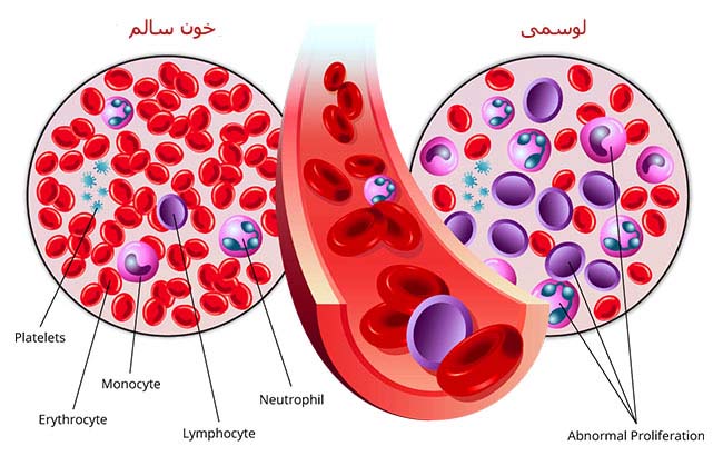 علائم ، تشخیص ، پیشگیری و درمان سرطان خون - پزشکی