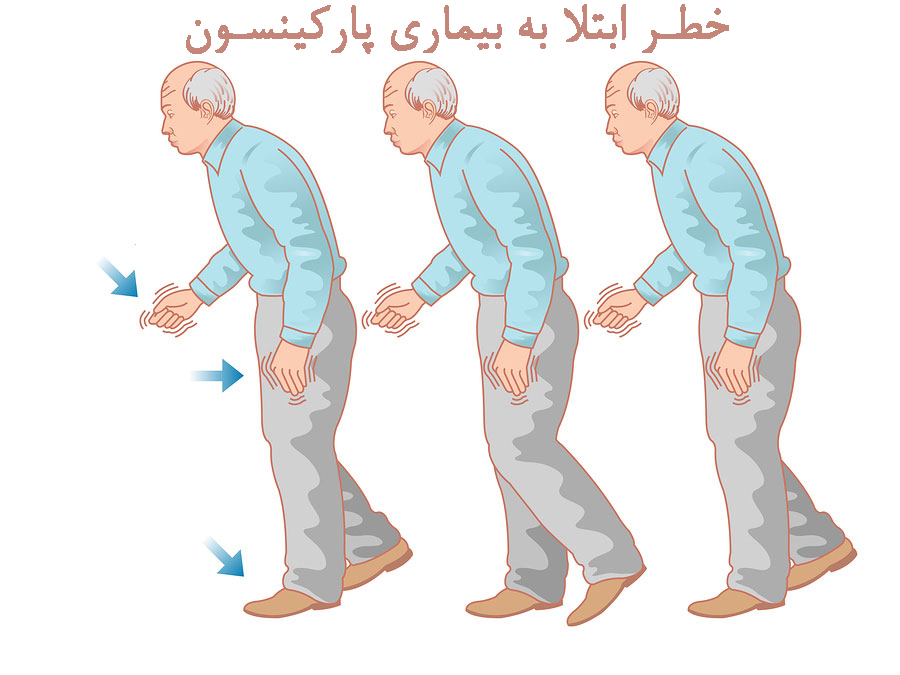 افزایش خطر ابتلا به بیماری پارکینسون