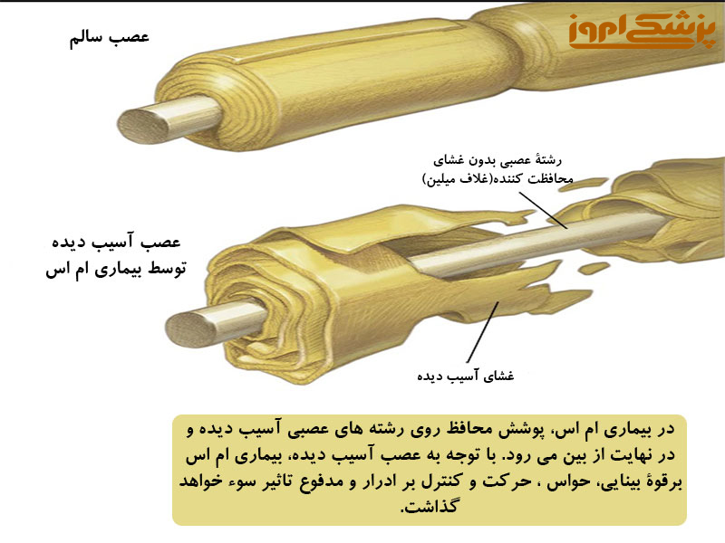 نشانه های بیماری ام اس چیست