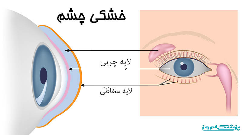 چگونگی خشکی چشم