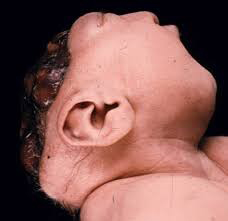 تصویر، تولد نوزاد مبتلا به این اختلال را نشان می دهد.