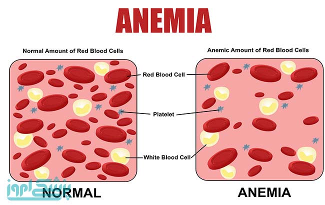 کم‌خونی‌
