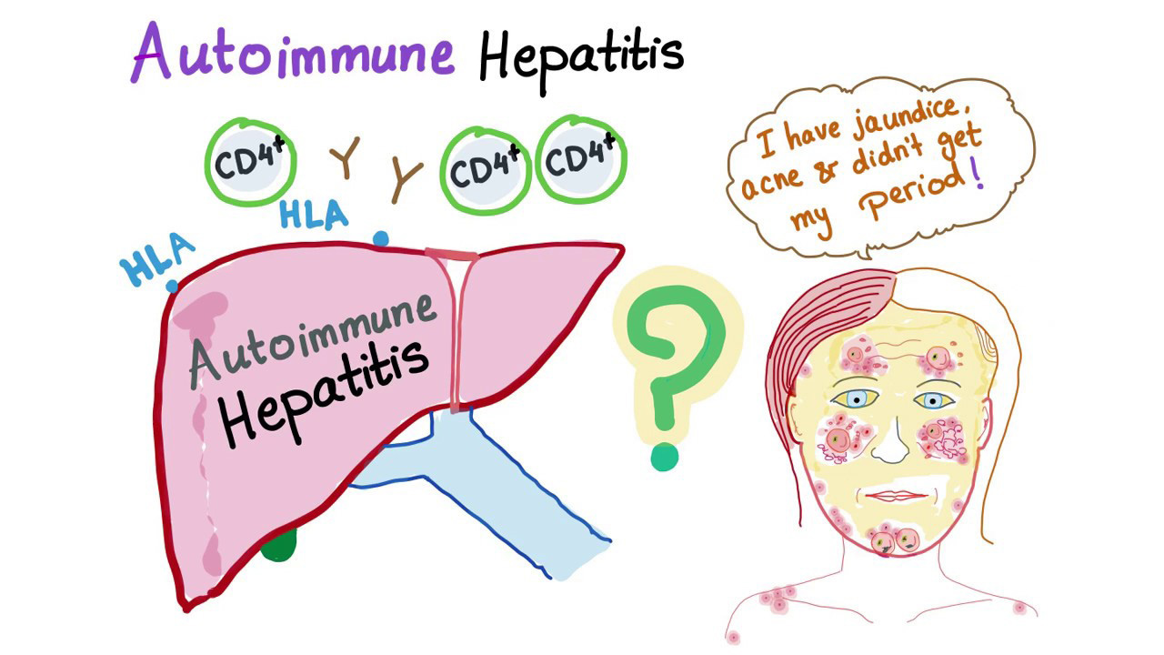 هپاتیت خودایمنی