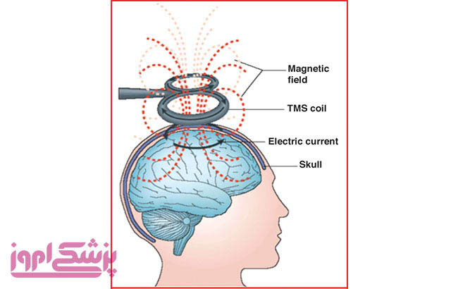  پارکینسون