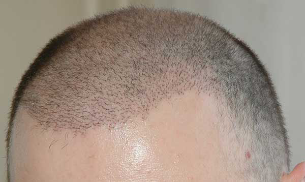 کاشت (پیوند) موی طبیعی