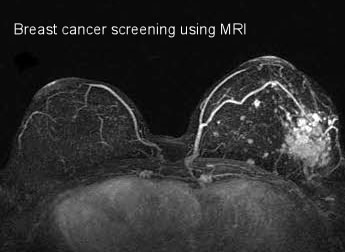 سرطان زودرس پستان و MRI