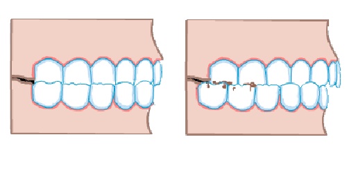 عوامل مؤثر دندان‌قروچه