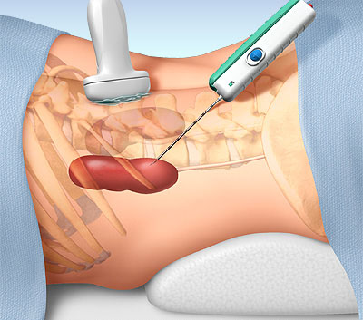 بیوپسی کلیه دریک نگاه