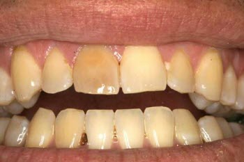 علت بدرنگ‌ ‌ ‌شدن دندان‌ها