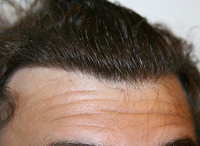 کاشت (پیوند) موی طبیعی (۳۵)