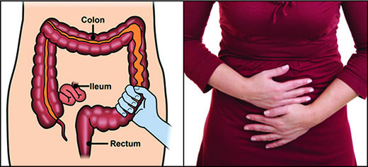 تشخیص سندرم روده تحریک پذیر (IBS)