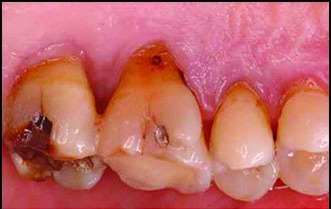 ازدیاد حساسیت دندان(۲)