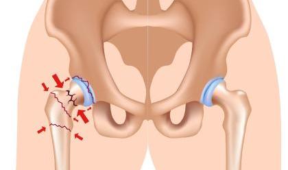 زولیپدم و خطر شکستگی هیپ