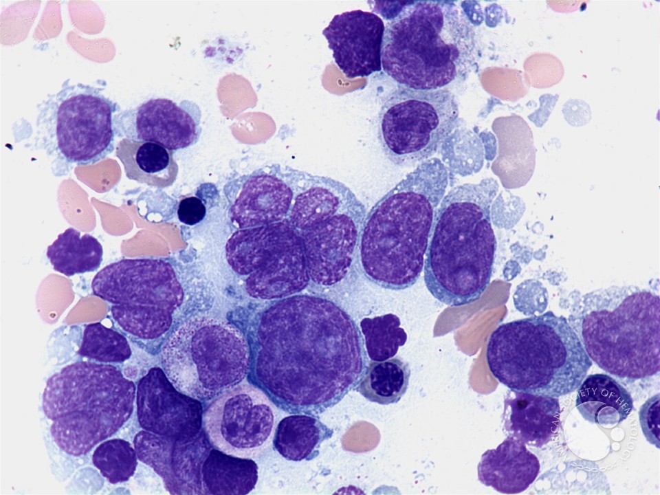 لنفوم منتشر B-Cell با هسته‌ی به‌شکل گل