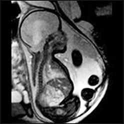تشخیص ناهنجاری های CNS با سونو و MRI