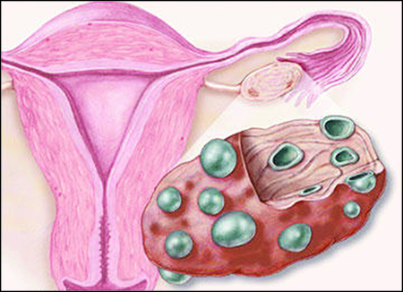 تخمدان چندکیستی و بستری شدن دربیمارستان 