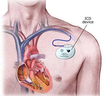 کاشت ICD‌‌ و لزوم تحرک بعدی