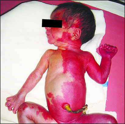 کودکی با نصف بدن قرمز