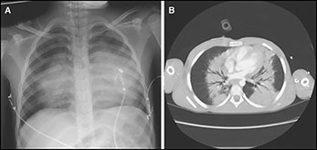 انفجار ریه (Blast Lung)