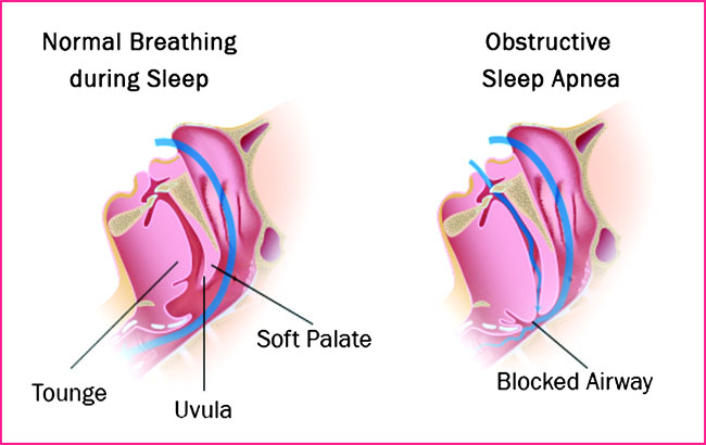 خطر وقفه‌های تنفسی حین‌‌خواب