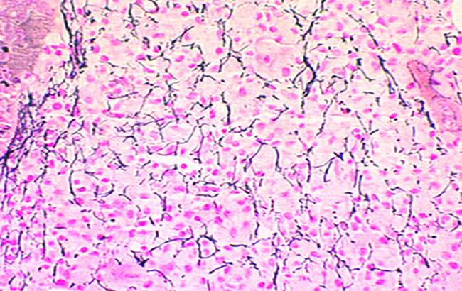 سرطان خون با سیتوپلاسم مویی شکل‌ (HCL)