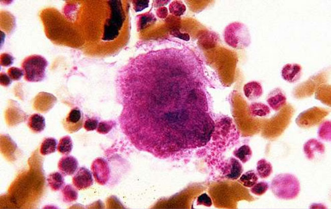 درمان ترومبوسیتوز در عارضه میلوپرولیفراتیو
