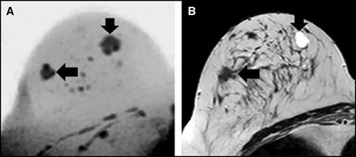 کاهش ضرورت بیوپسی پستان با استفاده از MRI