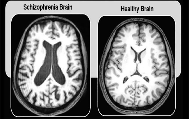 تفاوت در مغز بیماران دچار اسکیزوفرنی