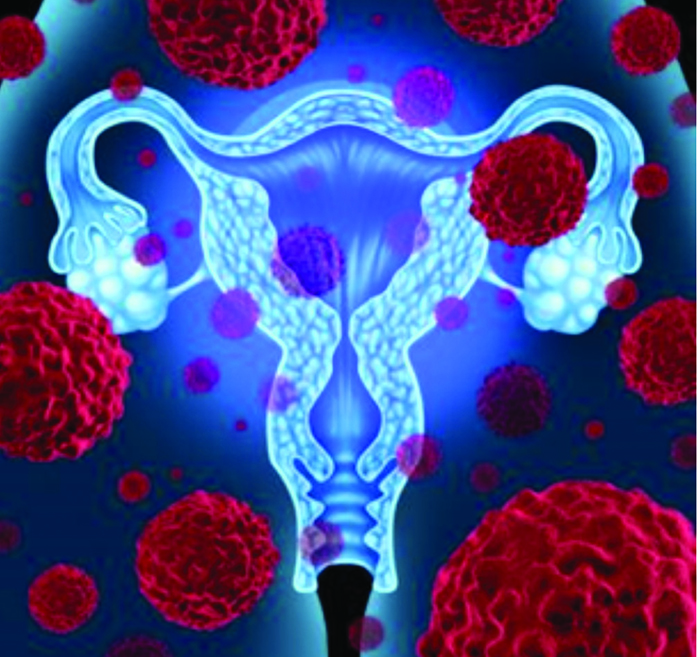 عدم پیش آگاهی زنان از سرطان تخمدان