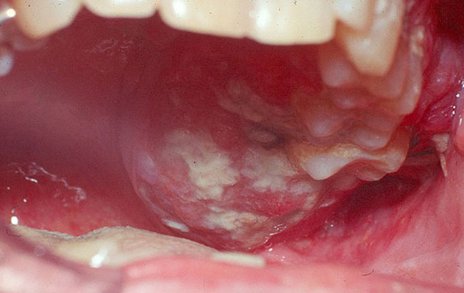 باکتری‌های ایجادکننده بیماری لثه، حامل رشد سرطان دهان