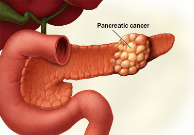 تشخیص زودهنگام سرطان پانکراس با آزمایش خون 