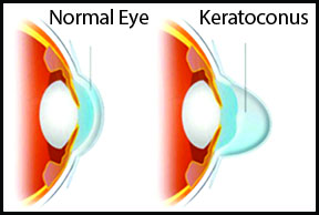 تسریع بهبودی بافت چشم پس از جراحی