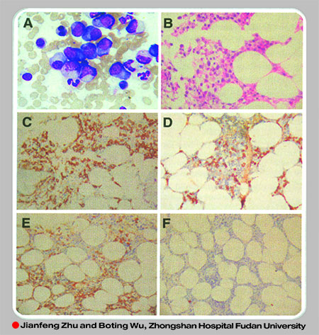 پلاسماسل میلوما با Immunoglobulin G4 مثبت