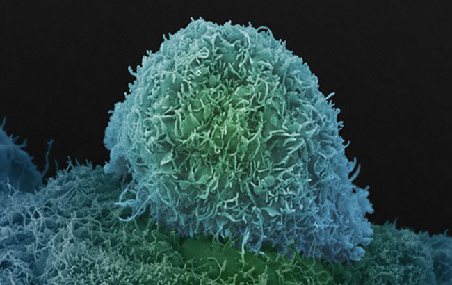 گردش سلول‌های سرطانی در خون و گسترش سرطان‌پروستات