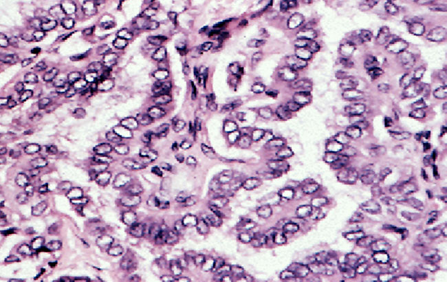 شناسایی نشانگر برای موارد مهاجم سرطان پاپیلاری‌تیروئید