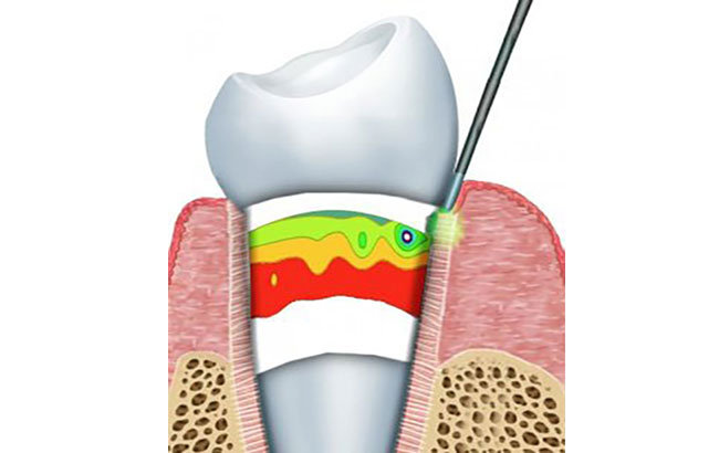 مزایای درمان توسط لیزر در مشکلات دندان
