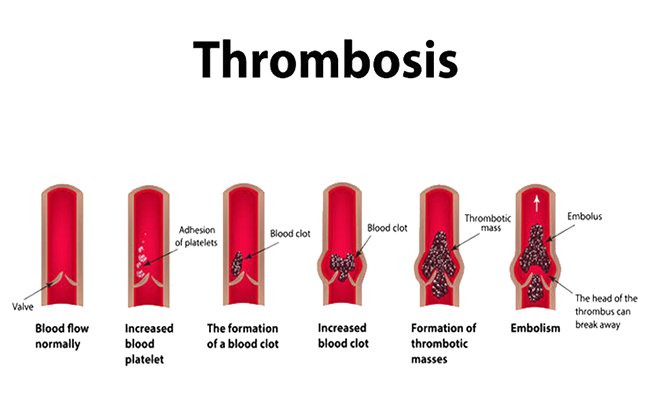 ترومبوز در سرطان‌ها