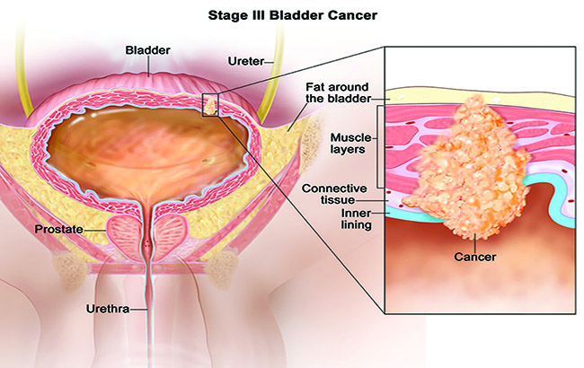تستی جدید و غیرتهاجمی برای سرطان‌ مثانه
