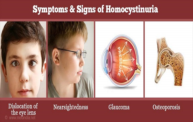 هوموسیستینوری؛ علل، نشانه‌ها و آزمایش‌ها