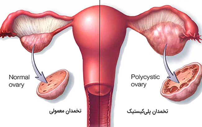 کلیاتی درمورد سندرم تخمدان‌پلی‌کیستیک و یائسگی