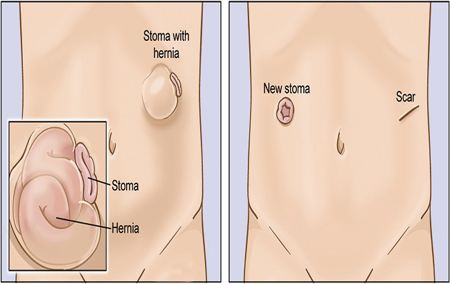 امکان درمان فتق پارا استومی بدون‌نیاز به عمل‌جراحی