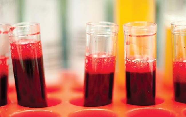 آزمایش خون جدید جهت پاسخ به درمان سرطان‌پروستات