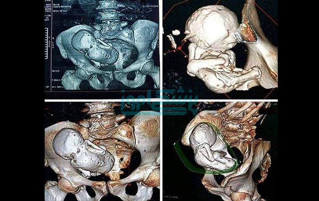 "کودک سنگی" سی ساله در بدن مادری هفتادوچهار ساله