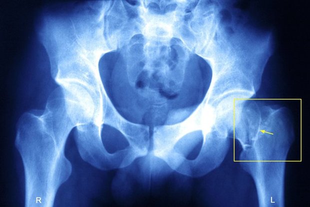 فعالیت فیزیکی ریسک شکستگی لگن را در زنان مسن کاهش می دهد