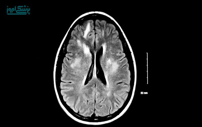 درمان بیماری ام اس