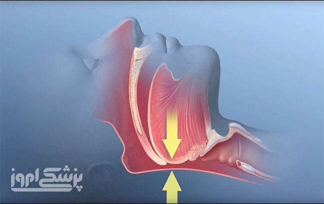 «تحریک عصبی» جایگزینCPAP در آپنۀ خواب