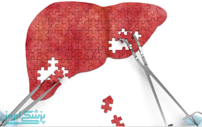 وضعیت هپاتیت و سرطان کبد در ایران