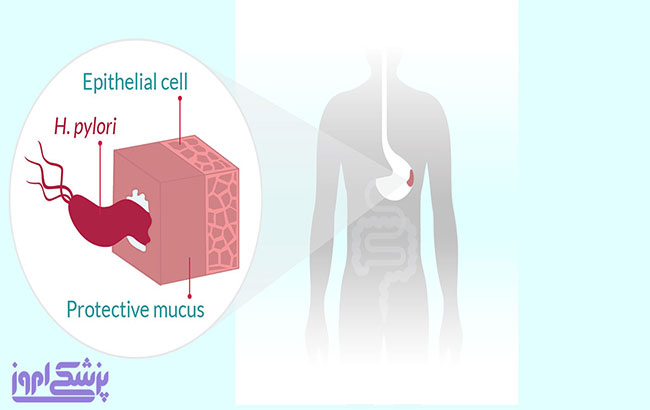 علائم ، عوارض و درمان عفونت هلیکوباکتر پیلوری
