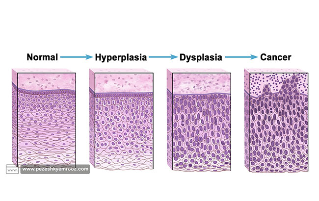  دیسپلازی| رحم| سلول| بافت| سرطان| کودکان| 